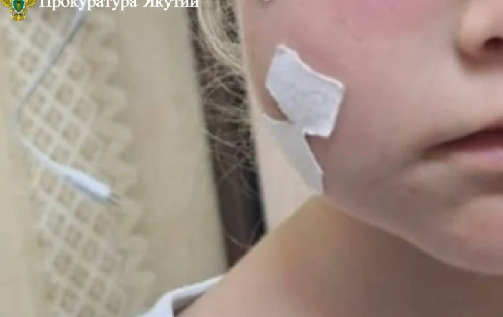 В Нерюнгри бездомная собака укусила трехлетнюю девочку за лицо: С администрации города взыскана компенсация