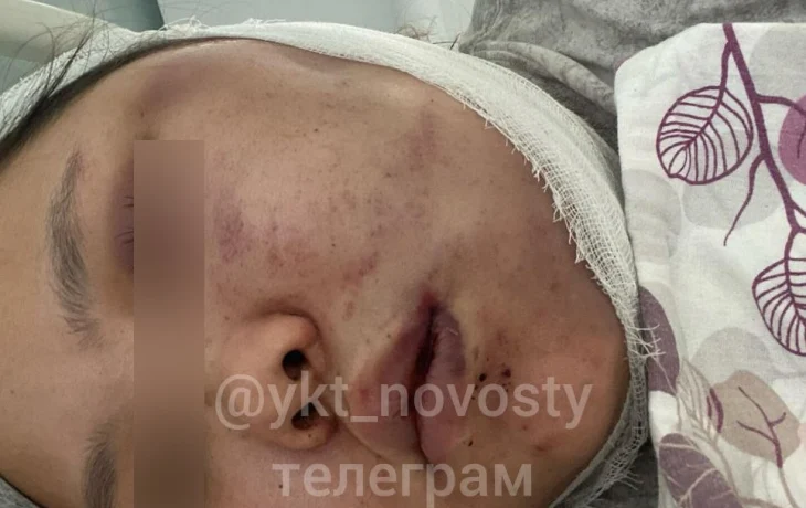 Переломы челюсти, сотрясение мозга: В Якутии мужчина, вернувшийся с СВО, жестоко избил сожительницу