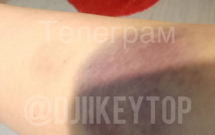 Жительница Якутска получила ушибы из-за врезавшегося в нее электросамокатчика: Горожанка просит запретить этот вид транспорта