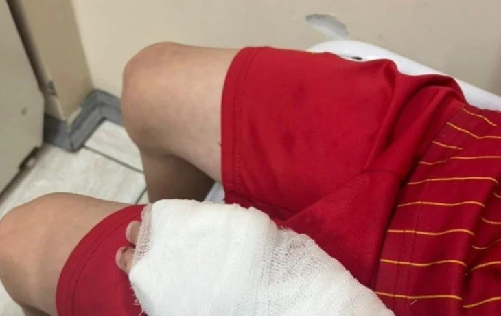 В Алдане покусанный собакой ребенок почти месяц страдает от ран, но никто еще не ответил за нападение животного
